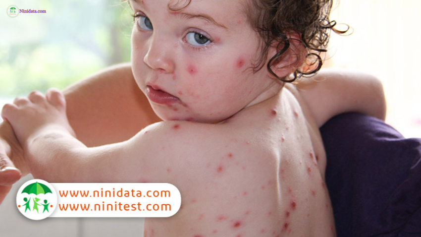 ninidata.com | آبله مرغان: علائم، درمان، روش های مراقبت و بهترین پزشکان شیراز